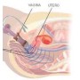 Electrostimulator perineal pentru incontinență Beac IntelliSTIM BE-28UG