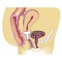 Pesario de silicona GELLHORN para prolapsos de 2.º, 3.º y 4.º grado, cistocele y rectocele